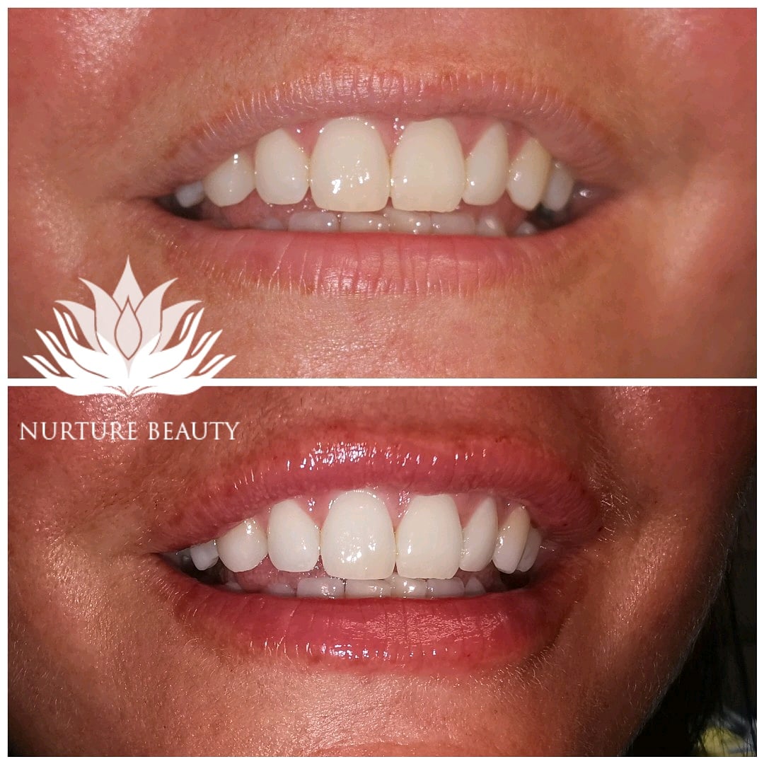 fillers1 Nurture Beauty Fillers Essex