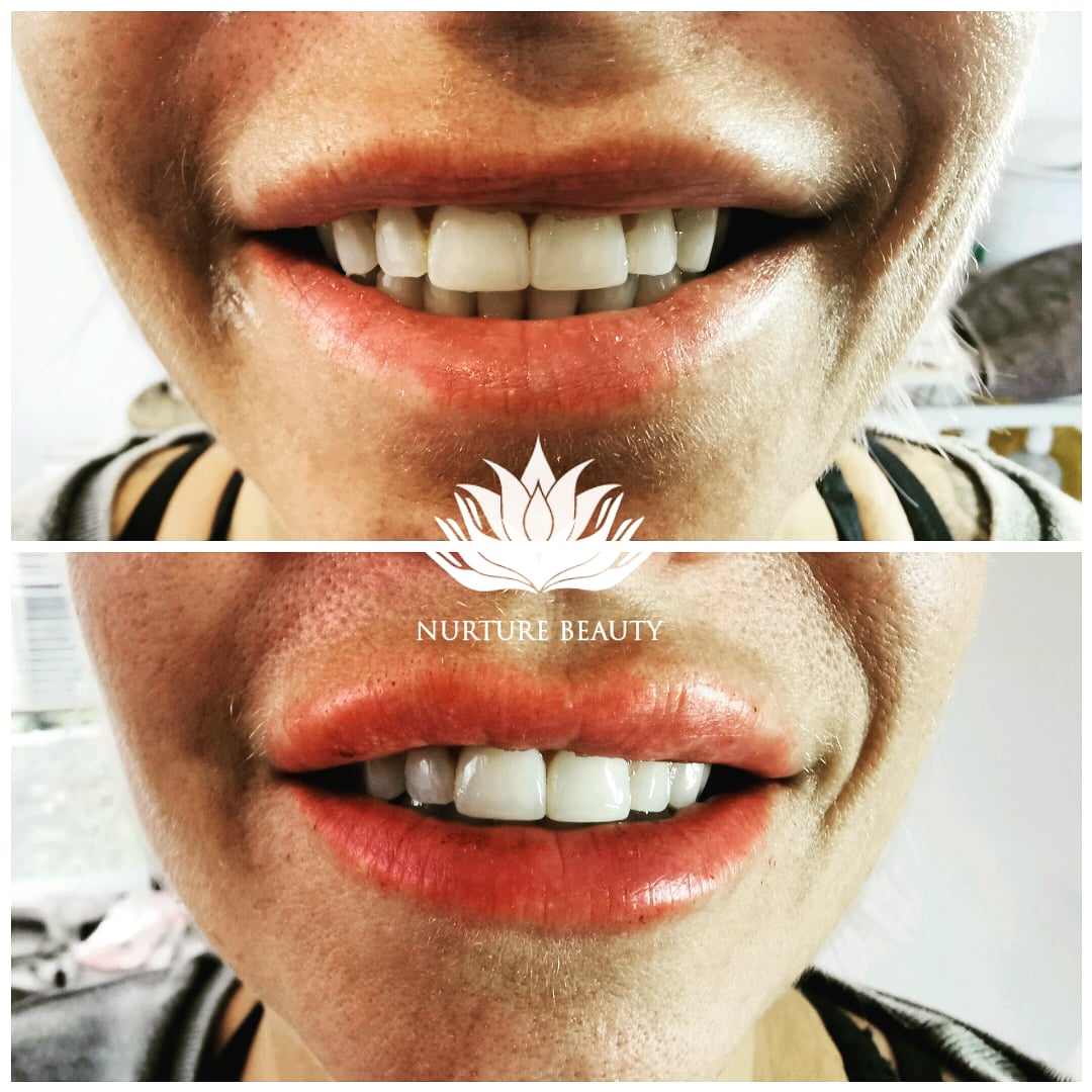 fillers2 Nurture Beauty Fillers